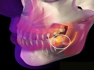智齿是指人类口腔内牙槽骨上最里面的第三颗磨牙,从正中的门牙往里数
