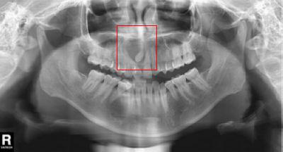 含牙囊肿多发生在下颌第三磨牙,上颌尖牙区也是好发部位.